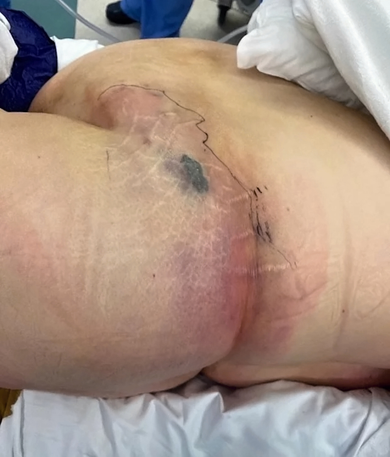 Necrotizing soft tissue infection