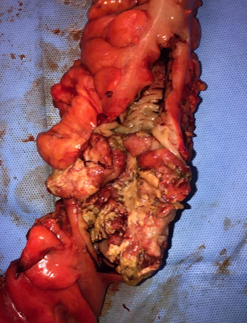 Necrotizing soft tissue infection