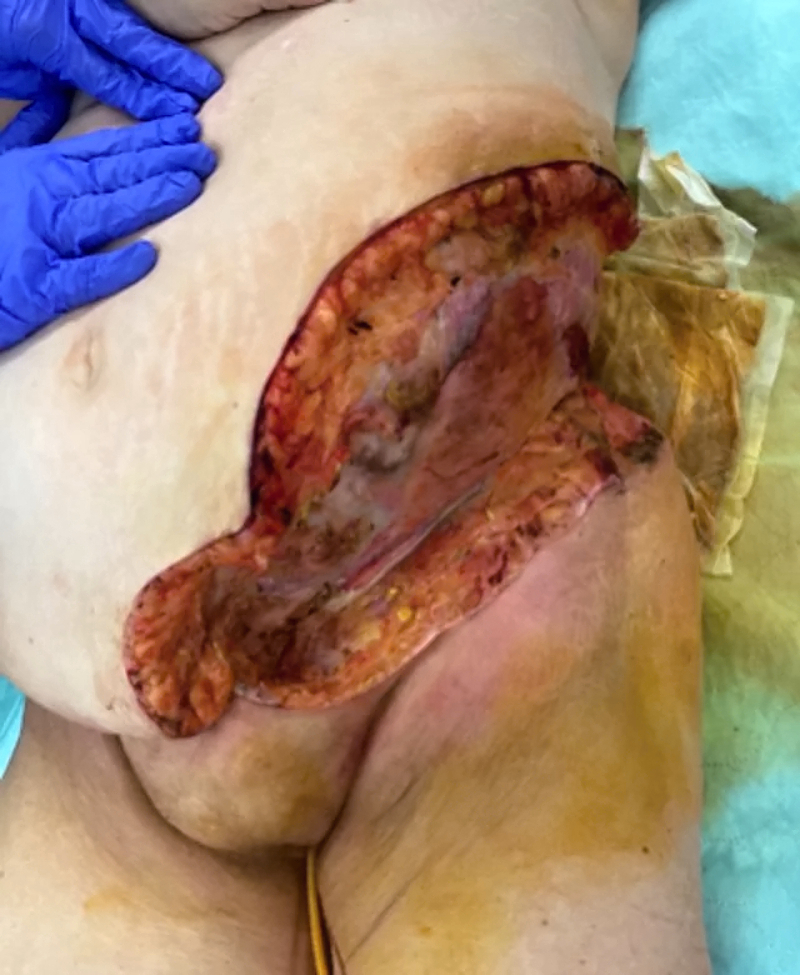 Necrotizing soft tissue infection