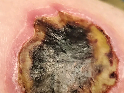 HotHands Burn-Day 1 to Week 5