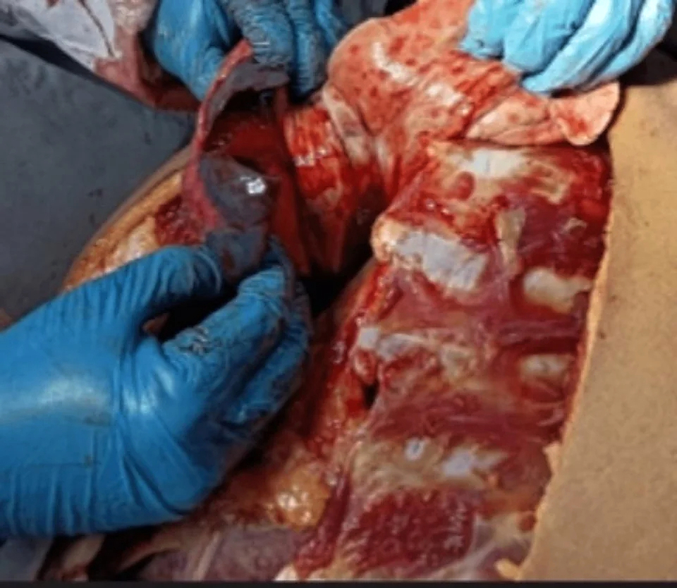 Post-obstructive pulmonary edema in delayed death by hanging