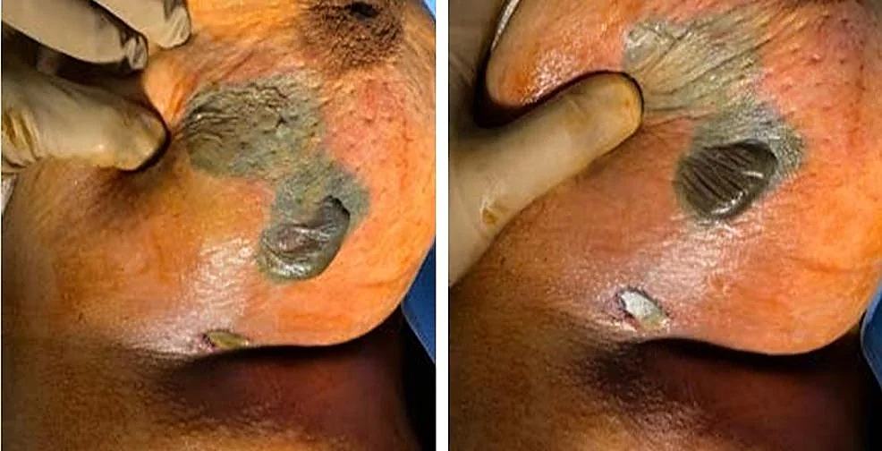 Necrotizing fasciitis of the breast