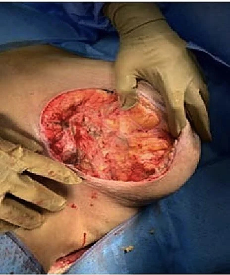 Necrotizing fasciitis of the breast