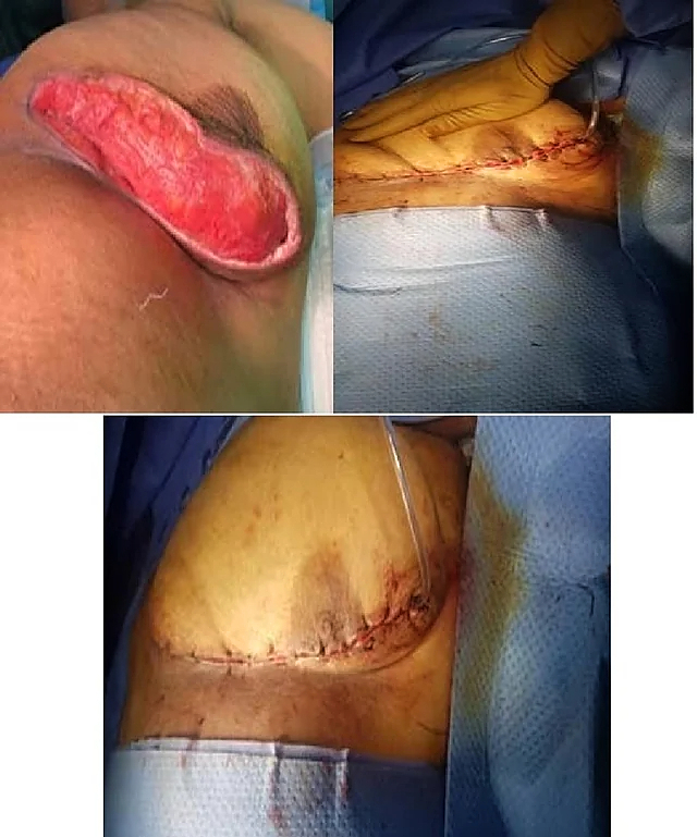 Necrotizing fasciitis of the breast