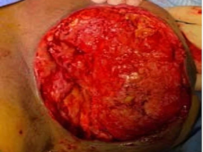 Necrotizing fasciitis of the breast