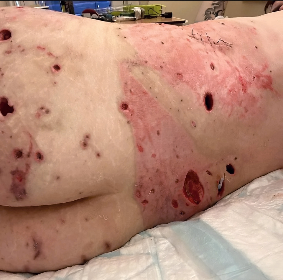 Foreign soldier fighting alongside UA hit by Russian bomb shrapnel