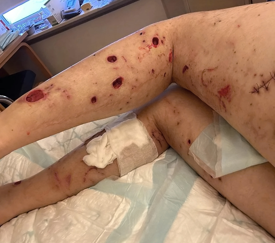 Foreign soldier fighting alongside UA hit by Russian bomb shrapnel