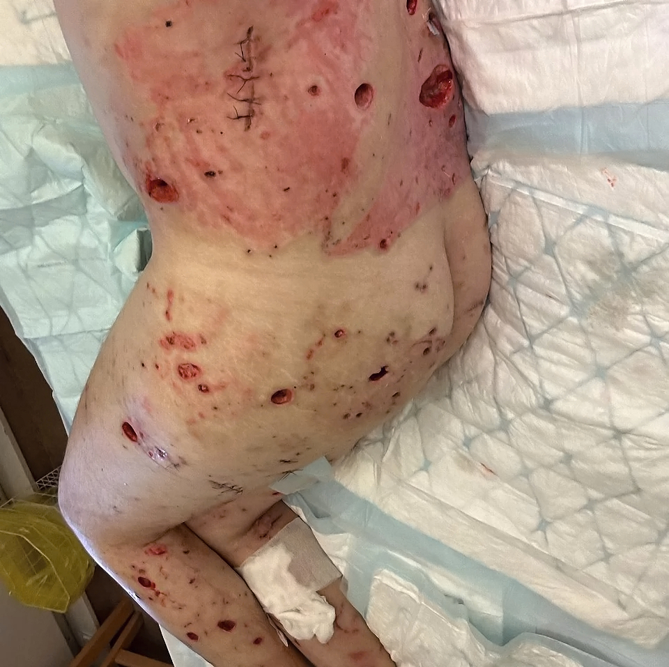 Foreign soldier fighting alongside UA hit by Russian bomb shrapnel