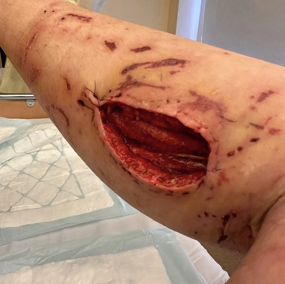 Foreign soldier fighting alongside UA hit by Russian bomb shrapnel