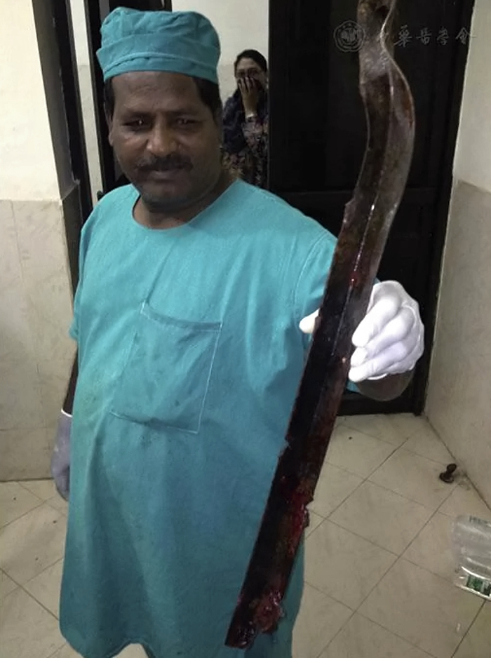 Thoracic impalement injury