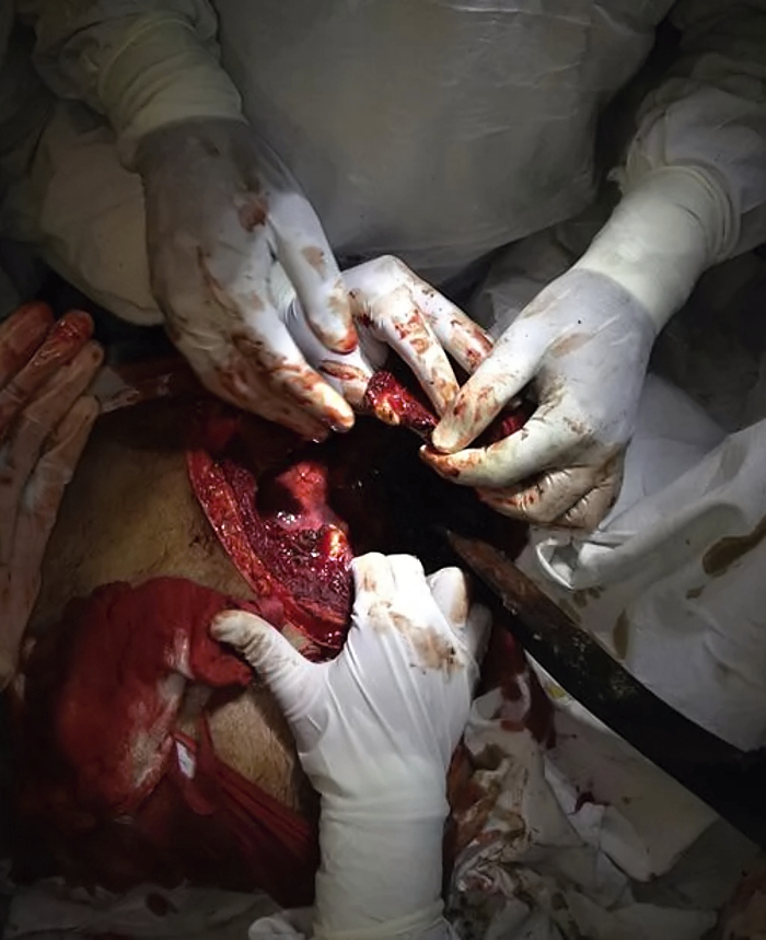 Thoracic impalement injury