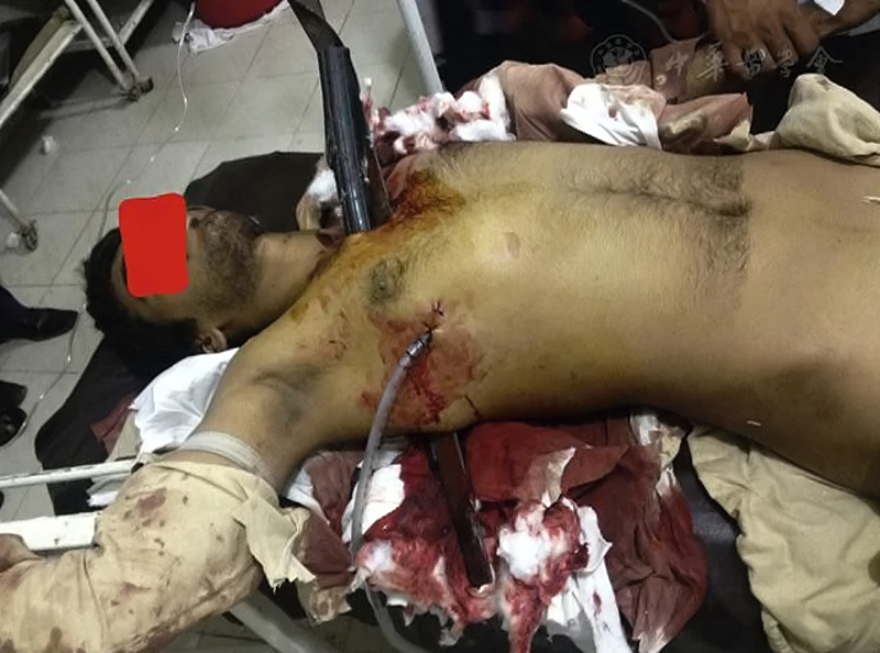 Thoracic impalement injury