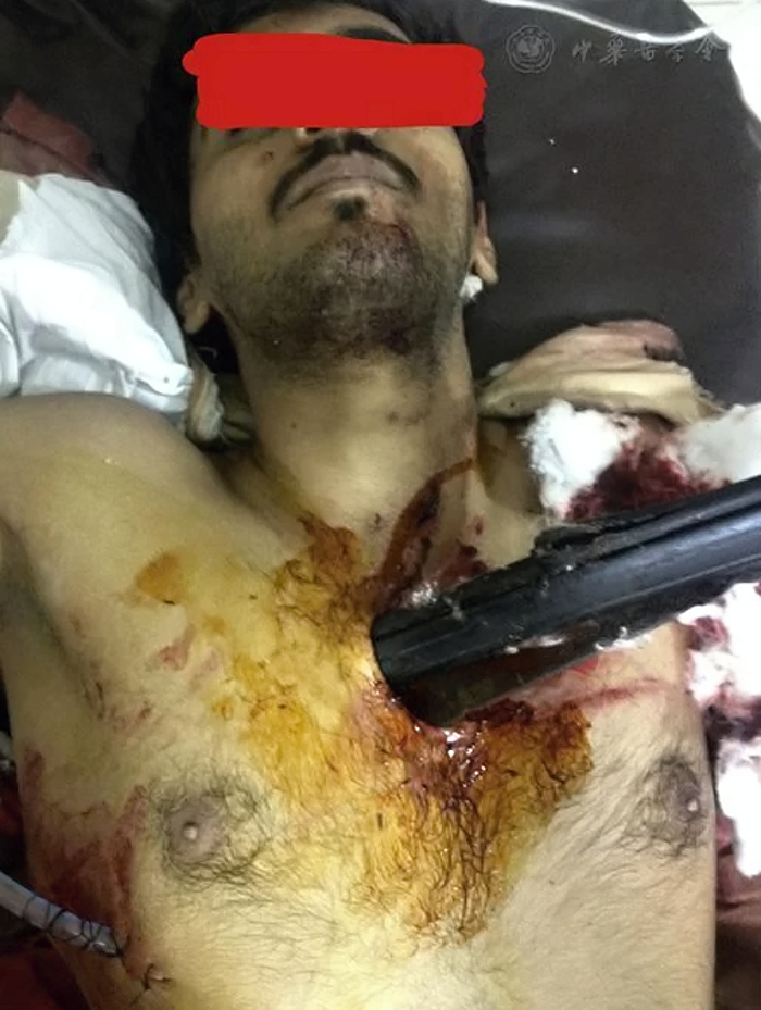 Thoracic impalement injury