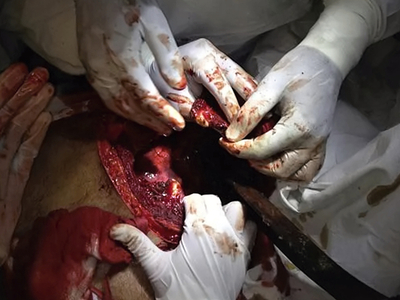 Thoracic impalement injury