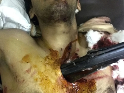 Thoracic impalement injury