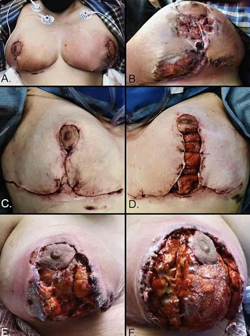 Pyoderma Gangrenosum After Breast Reduction