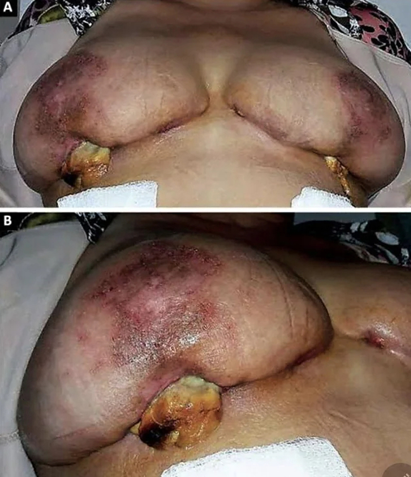 Pyoderma Gangrenosum After Breast Reduction
