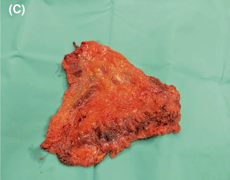 Multiple myeloma of the scalp