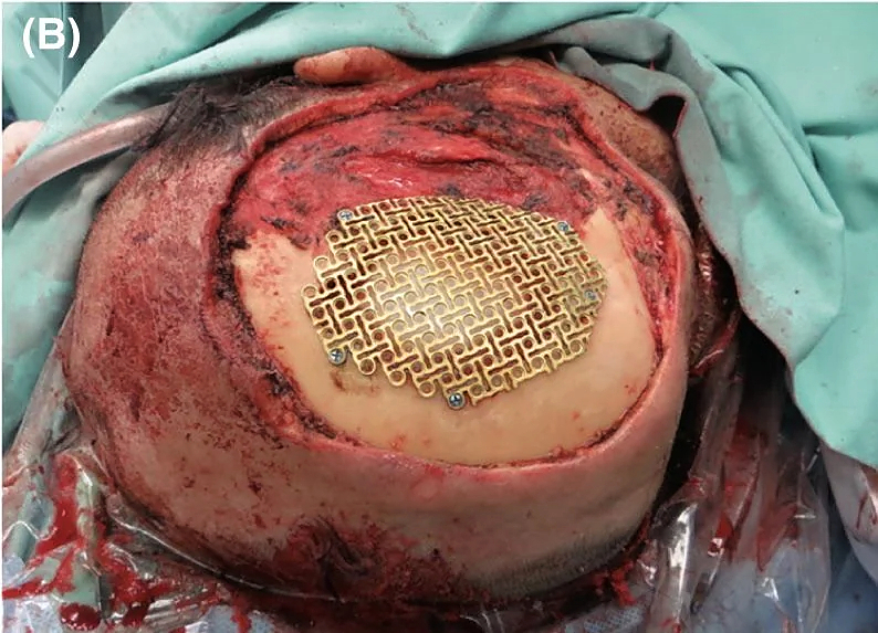 Multiple myeloma of the scalp