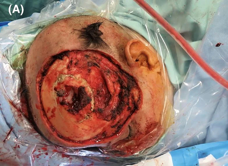 Multiple myeloma of the scalp