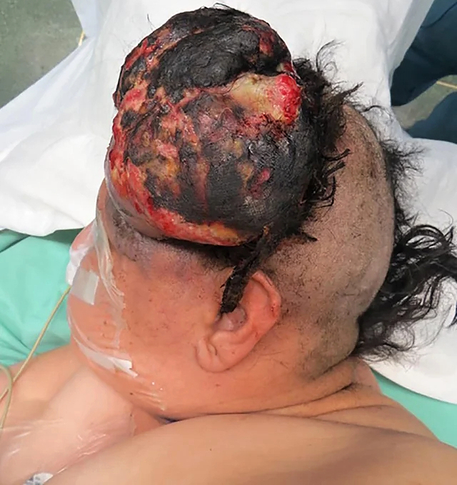 Multiple myeloma of the scalp