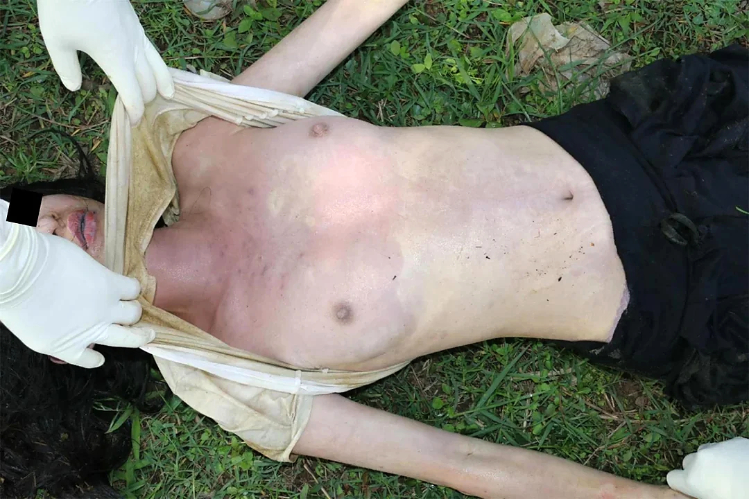 21 Year Old Murder by Drowning Woman Forensic Exam