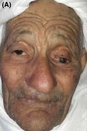 An “enormous” gossypiboma