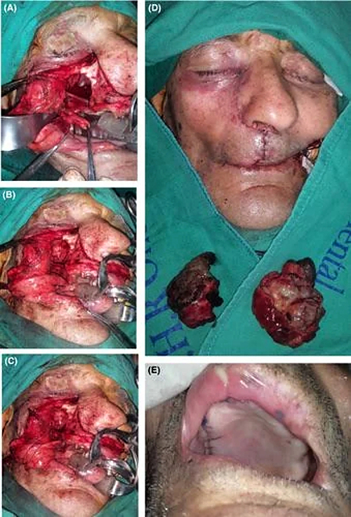 An “enormous” gossypiboma