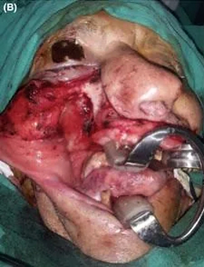 An “enormous” gossypiboma