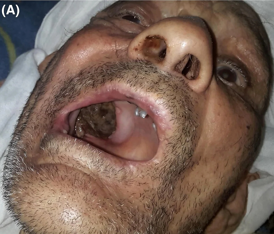 An “enormous” gossypiboma