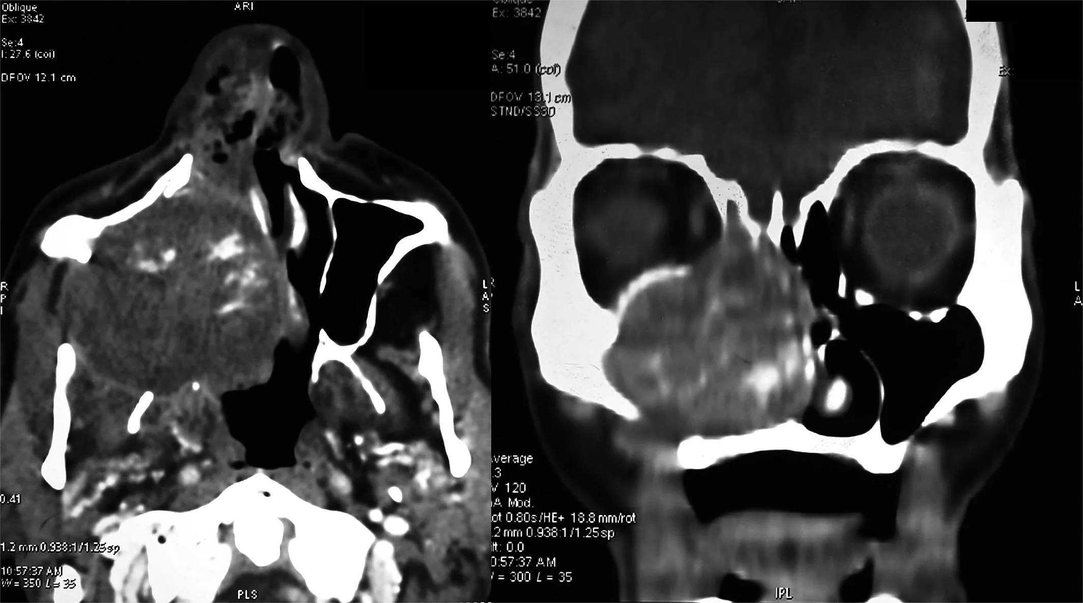 An “enormous” gossypiboma