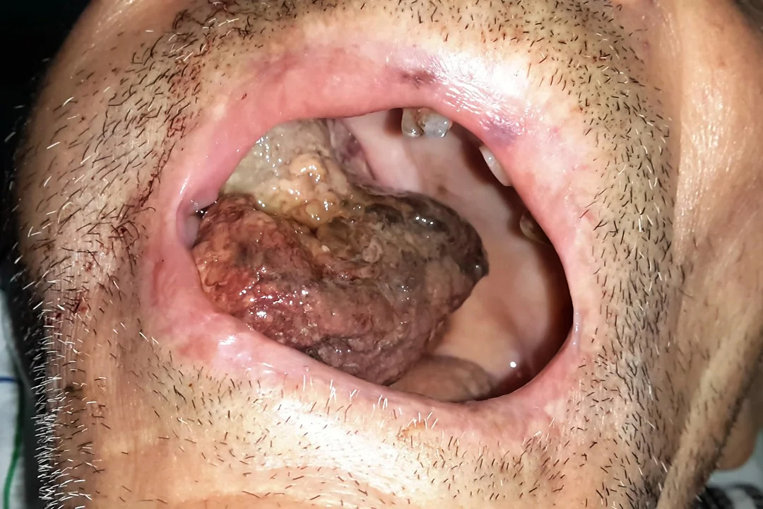 An “enormous” gossypiboma