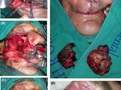 An “enormous” gossypiboma