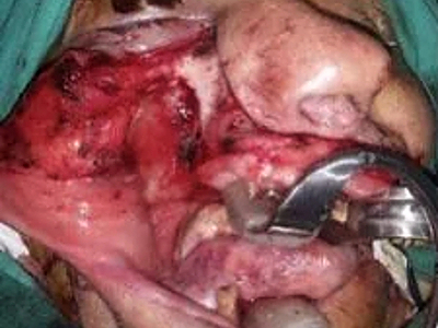 An “enormous” gossypiboma