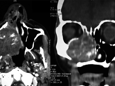 An “enormous” gossypiboma