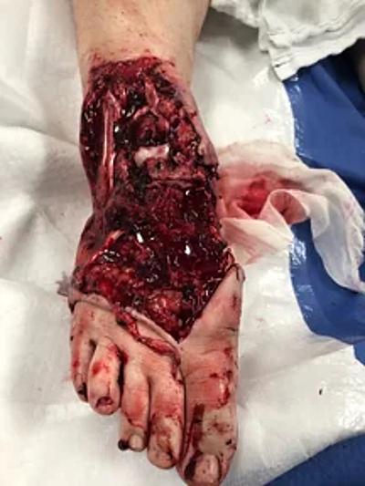 Compilation of shotgun wounds