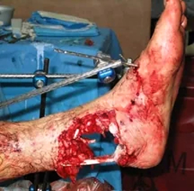 Compilation of shotgun wounds