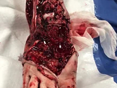 Compilation of shotgun wounds