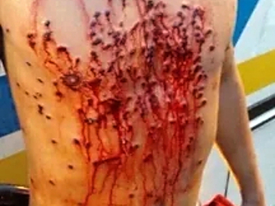 Compilation of shotgun wounds