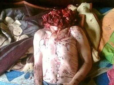 Compilation of shotgun wounds