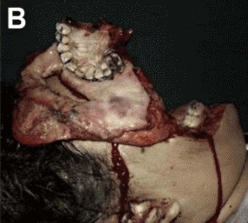 Face entirely reconstructed after accident