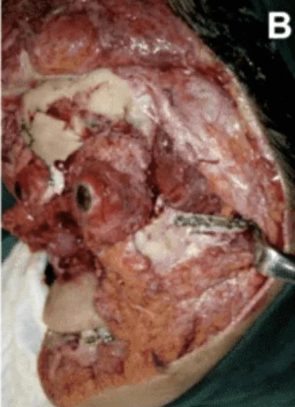 Face entirely reconstructed after accident