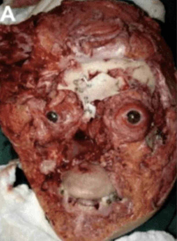 Face entirely reconstructed after accident