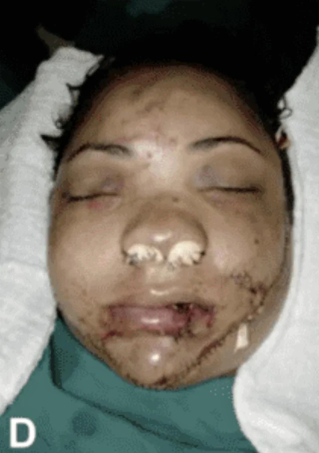 Face entirely reconstructed after accident