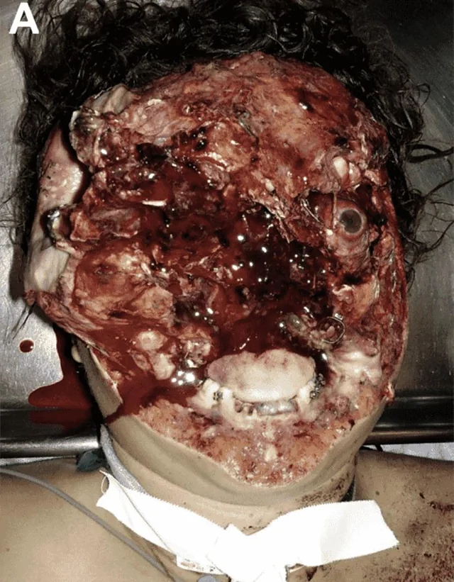 Face entirely reconstructed after accident