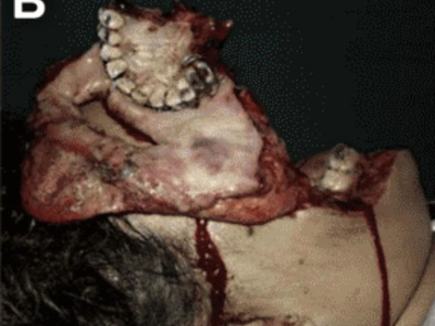 Face entirely reconstructed after accident