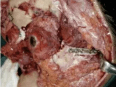 Face entirely reconstructed after accident