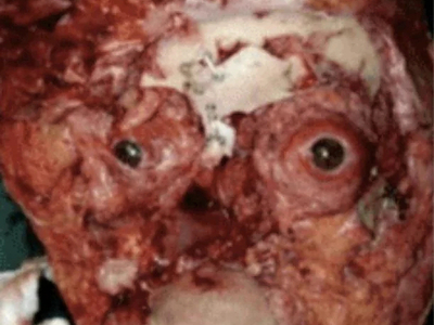 Face entirely reconstructed after accident