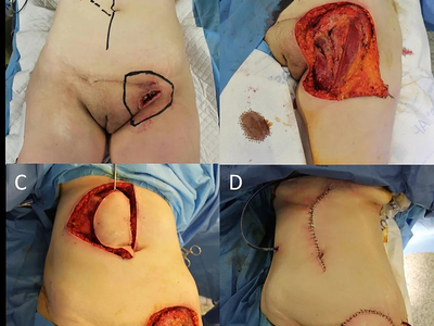 Locally advanced squamous cell carcinomas