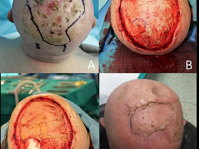 Locally advanced squamous cell carcinomas